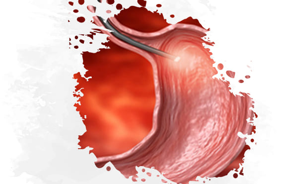 Candidatos para una Endoscopia